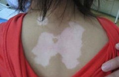 患有白癜風(fēng)能做美國試管嬰兒嗎?