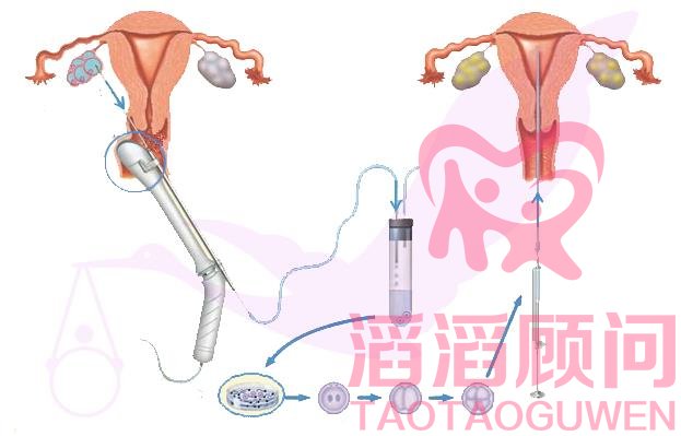 試管嬰兒的卵子怎么取出來?