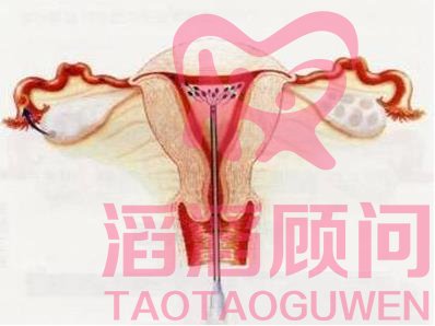 做試管嬰兒需要做輸卵管造影嗎?