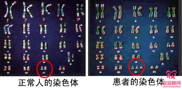 為什么發(fā)生染色體異常