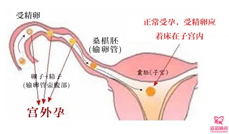 β-hCG值判斷是否宮外孕