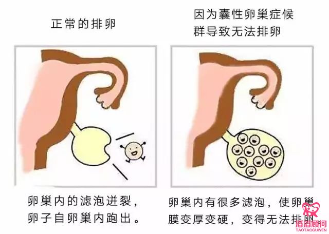 多囊卵巢綜合征