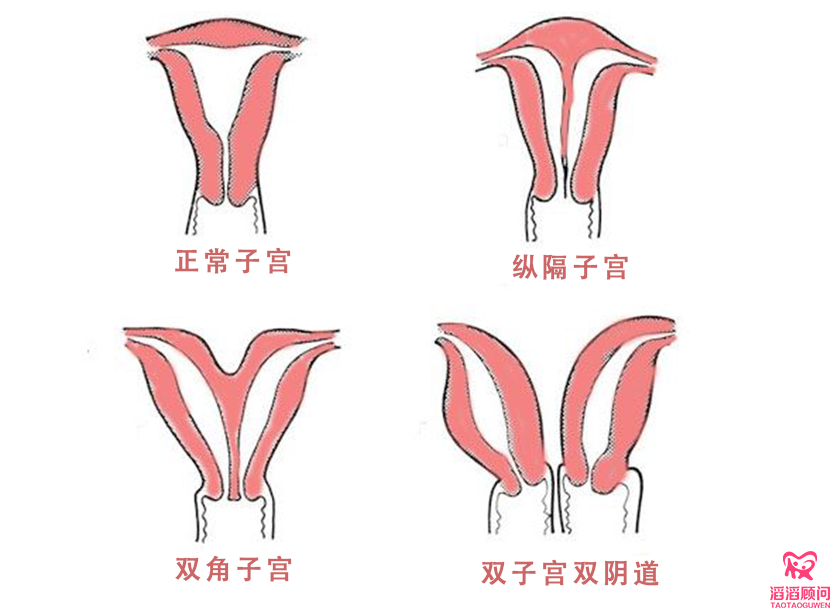 子宮畸形的危害