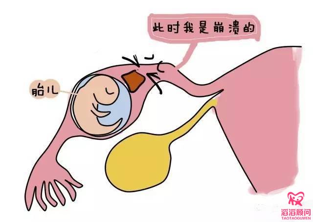 宮外孕
