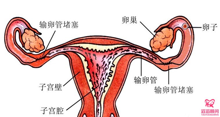 輸卵管堵塞