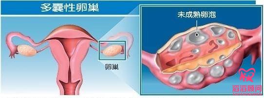 俄羅斯試管嬰兒