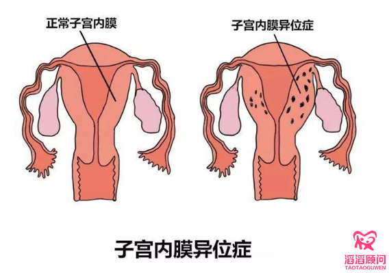 俄羅斯試管嬰兒