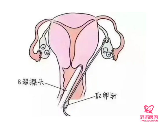 俄羅斯試管嬰兒