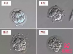 第三代試管嬰兒囊胚檢測怎么樣？
